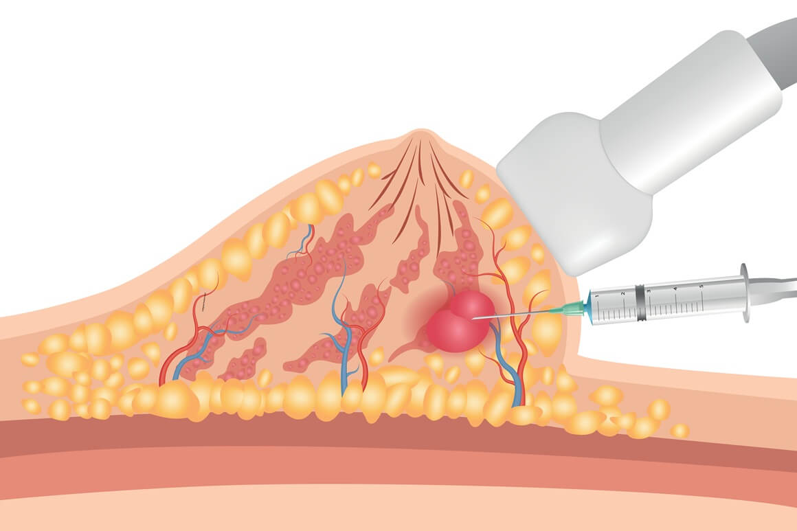 Citološka punkcija dojke privatno - cijena