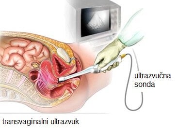 transvaginalni_ultrazvuk
