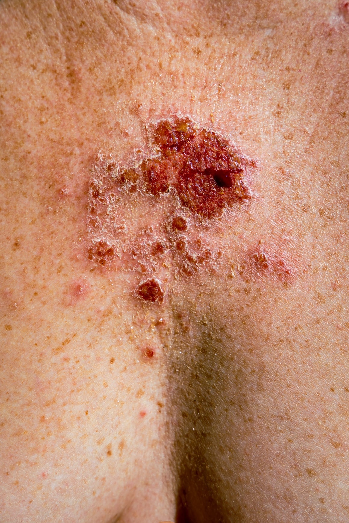 Bazocelularni karcinom - iskustva