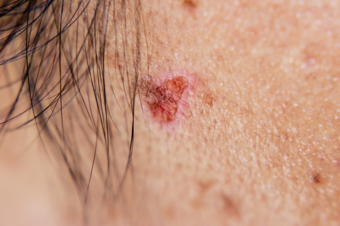 Bazocelularni karcinom