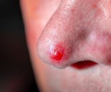 bazocelularni karcinom nosa