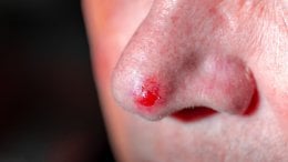 bazocelularni karcinom nosa