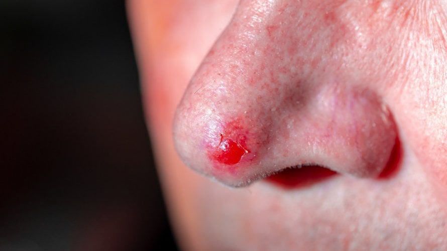 bazocelularni karcinom nosa