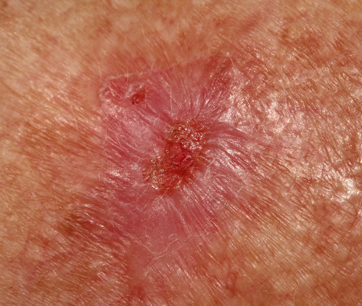 bazocelularni karcinom, smrtnost