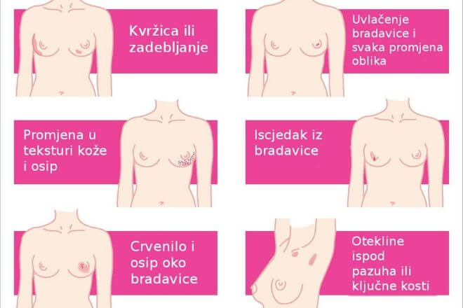 Simptomi raka dojke