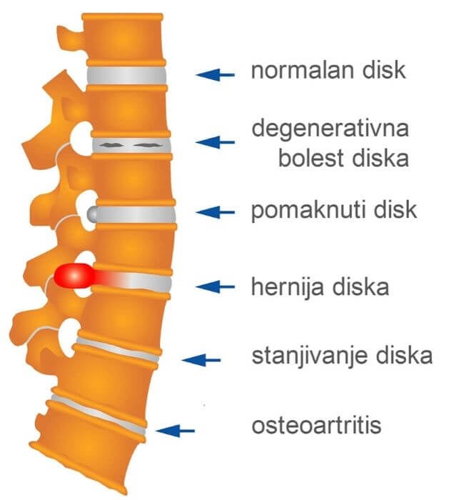 Bol u leđima i kralježnici