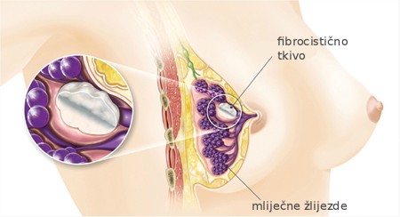 fibrocisticne_dojke