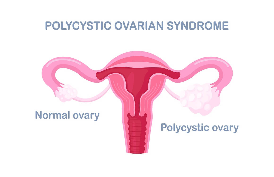 Ciste na jajnicima mogu spriječiti ili odgoditi ovulaciju zbog čega može doći do izostanka ili kašnjenja menstruacije