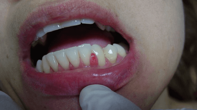 granulom-zuba