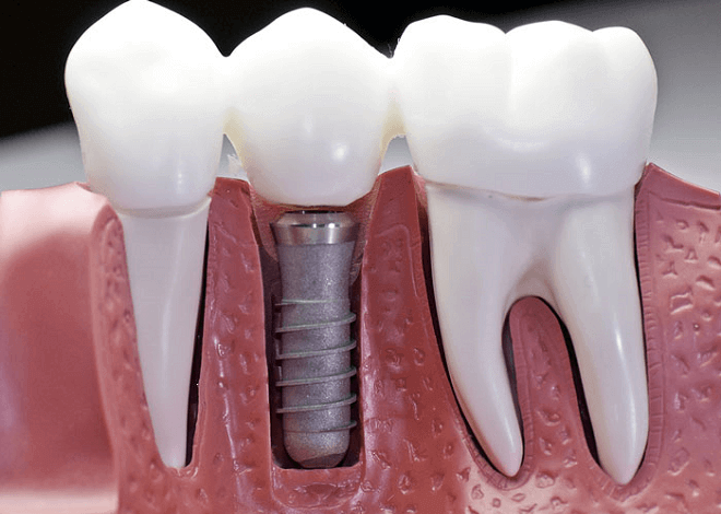 zubni-implantanti