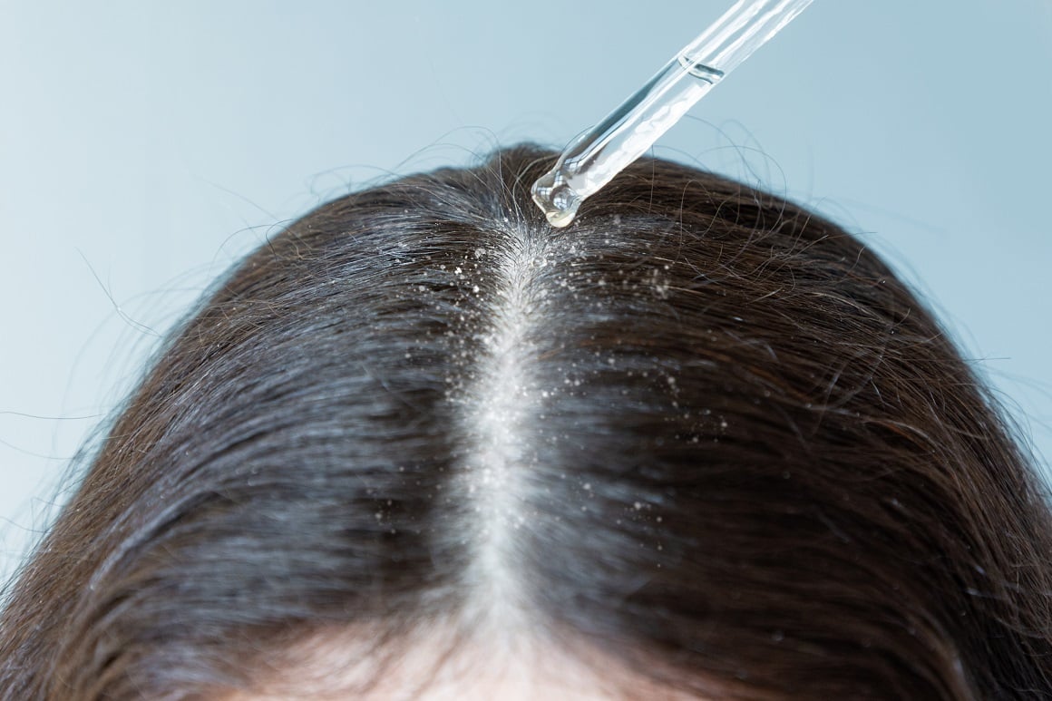 Perut u kosi - liječenje