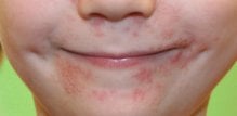 perioral-dermatitis3