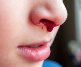 Krv iz nosa kod djece Zašto se javlja i kako je zaustaviti
