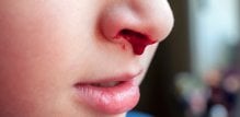 Krv iz nosa kod djece Zašto se javlja i kako je zaustaviti