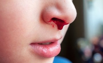 Krv iz nosa kod djece Zašto se javlja i kako je zaustaviti