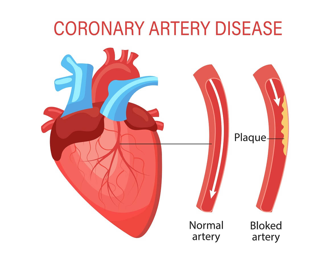 Ateroskleroza koronarnih arterija