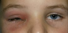 celulitis