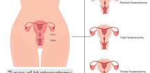 Histerektomija maternice