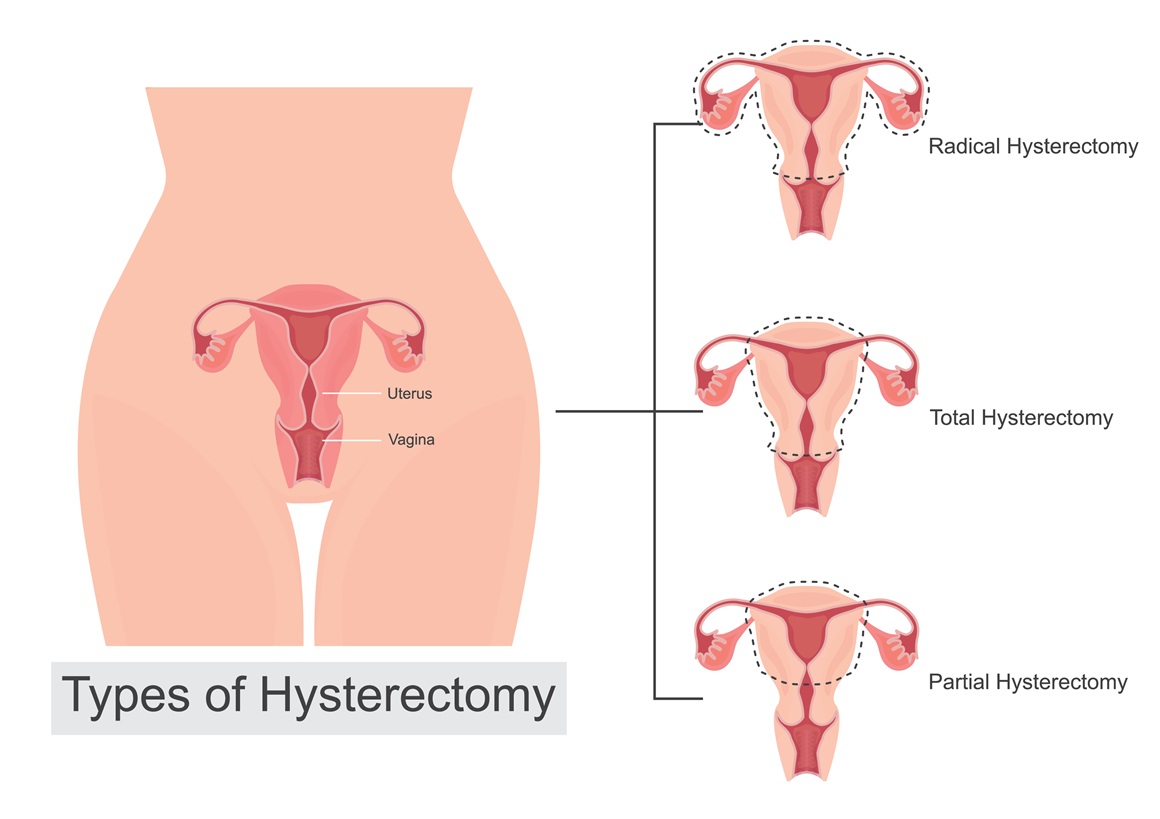 Histerektomija maternice