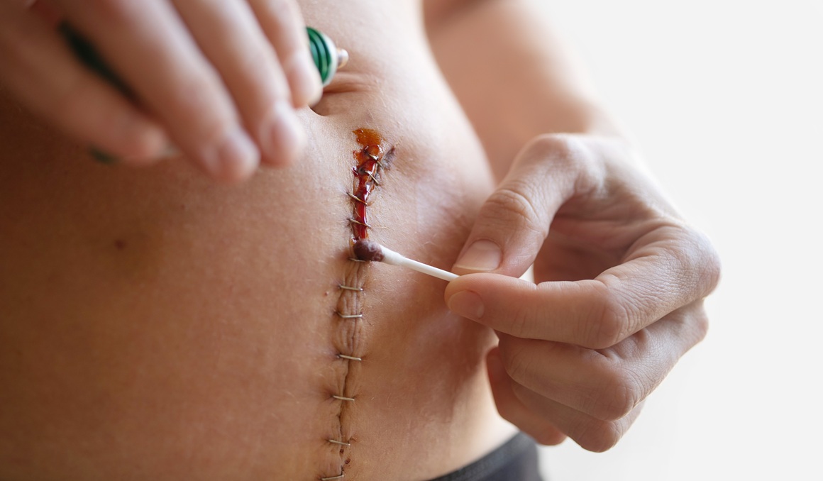 Histerektomija - posljedice