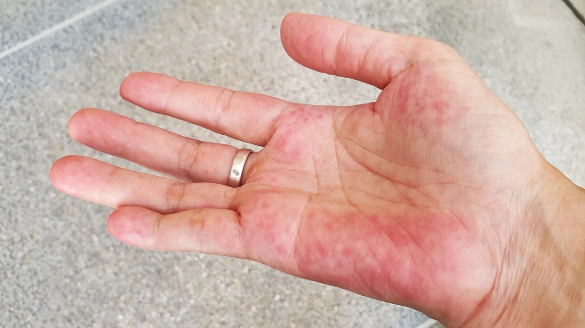 Lupus