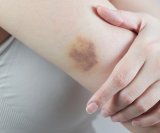 Modrice po tijelu mogu biti znak ozbiljne bolesti Evo kada morate liječniku