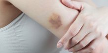 Modrice po tijelu mogu biti znak ozbiljne bolesti Evo kada morate liječniku