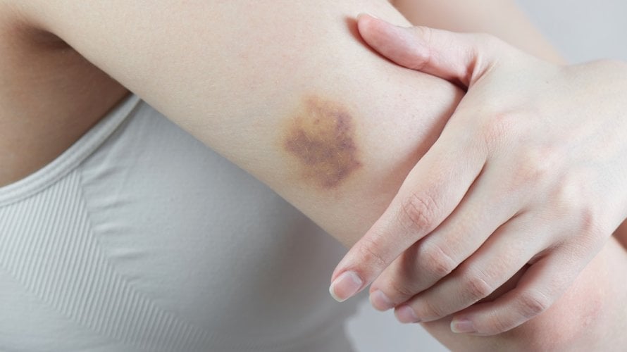 Modrice po tijelu mogu biti znak ozbiljne bolesti Evo kada morate liječniku