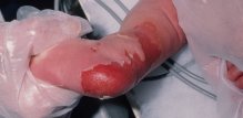 bulozna-epidermoliza