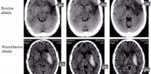 ct-mozga-kod-afazije