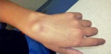 ganglion_na_ruci