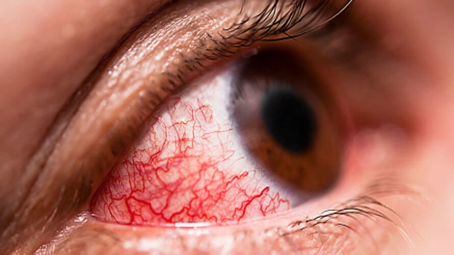 krvarenje u oku u hipertenzije