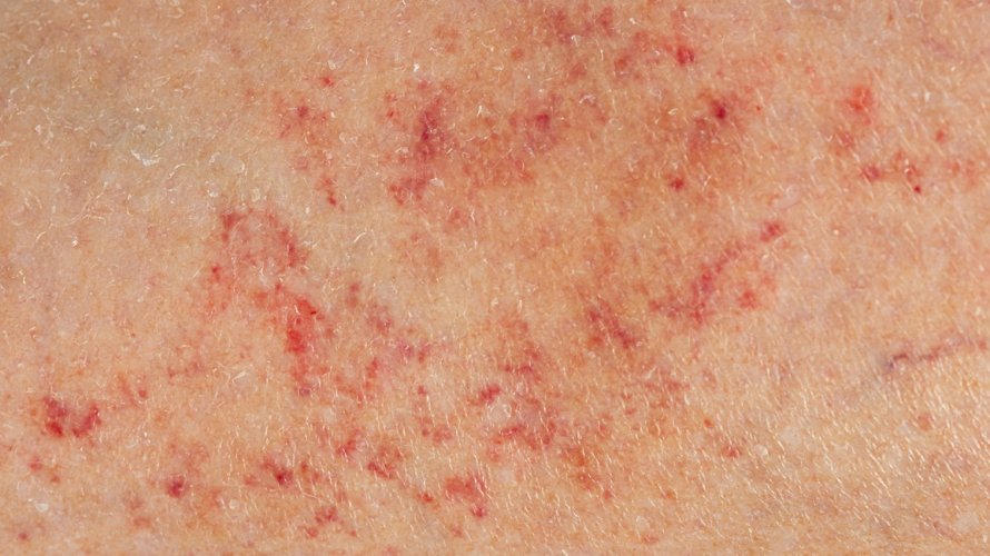 Meningokokna sepsa