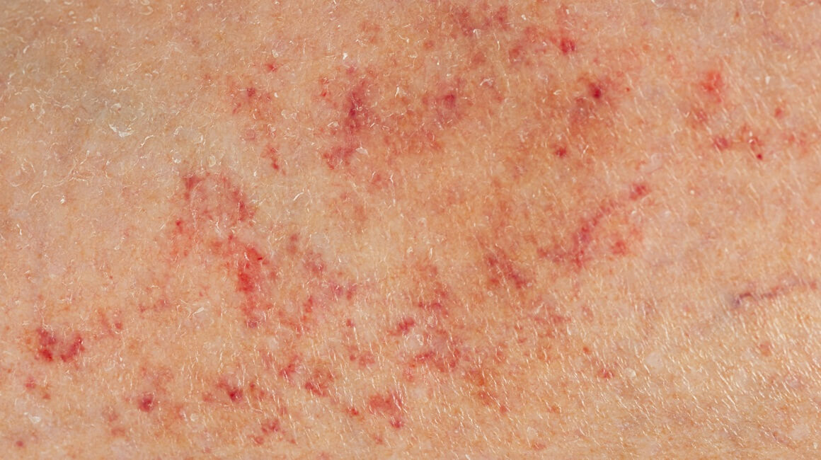 Meningokokna sepsa