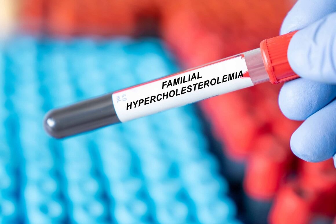 Obiteljska ili primarna hiperkolesterolemija
