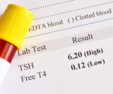 Povišen TSH i hipotireoza
