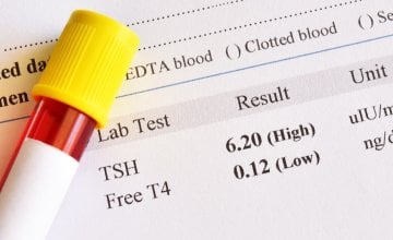Povišen TSH i hipotireoza