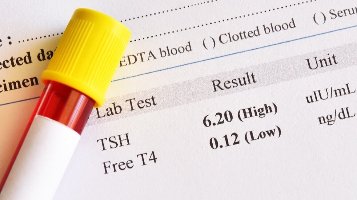 Povišen TSH i hipotireoza