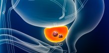 Rak prostate