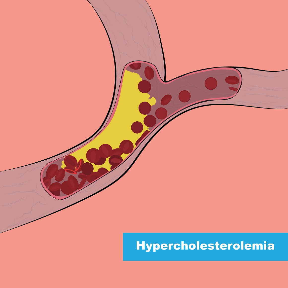 Uzroci hiperkolesterolemije