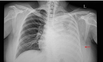 Voda u plućima ili pleuralni izljev Što se događa u tijelu kad se tekućina počne nakupljati