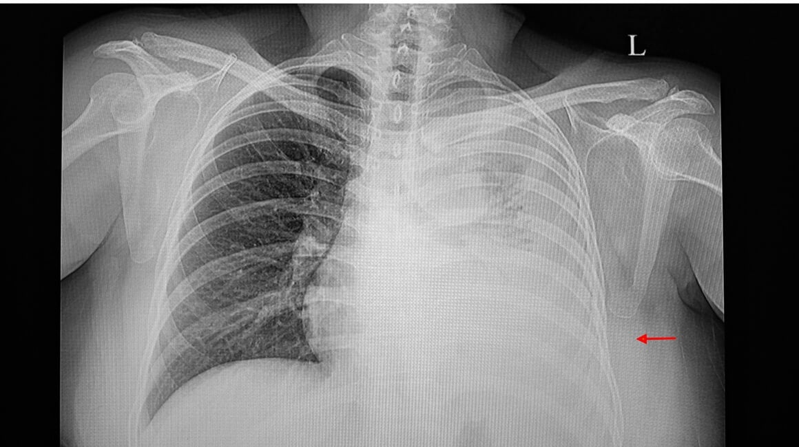Voda u plućima ili pleuralni izljev Što se događa u tijelu kad se tekućina počne nakupljati