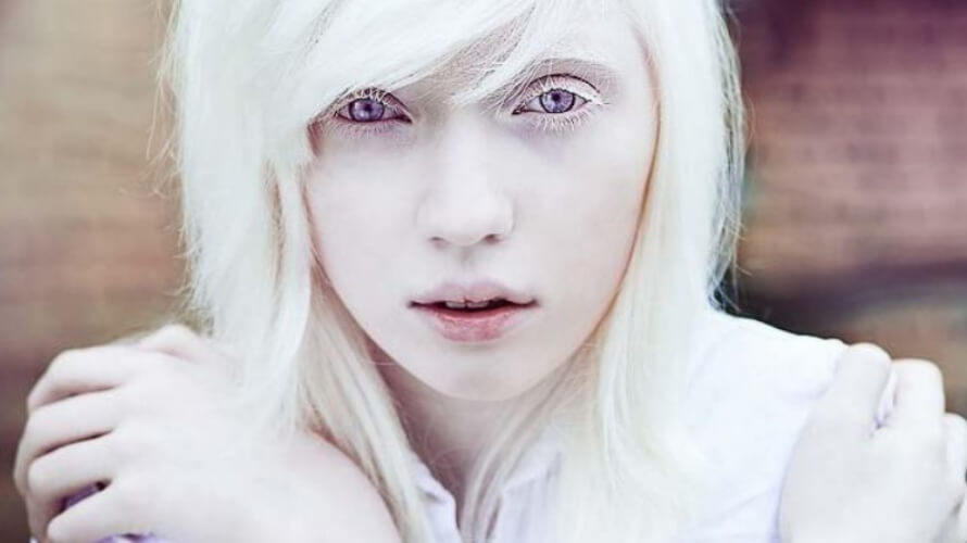 albinizam