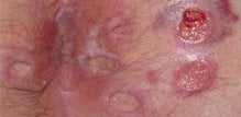 analni herpes