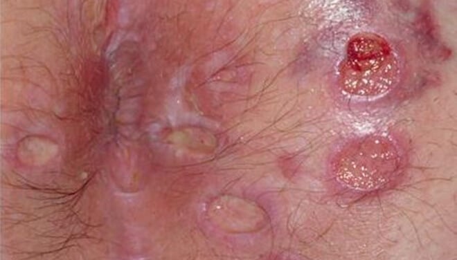 analni herpes