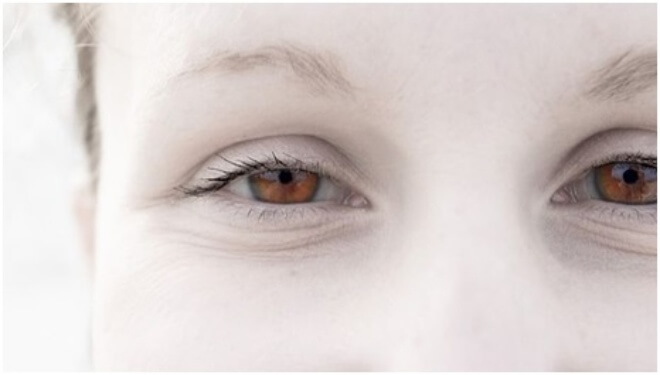 boja ociju albinizam