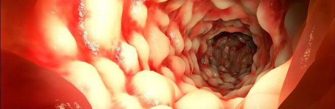 Crijeva kod crohnove bolesti