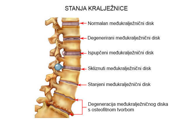Bol u vratnoj kralježnici: uzroci, liječenje, prevencija