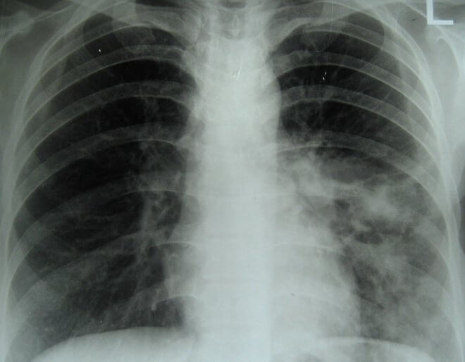 Rendgen fibroze pluća