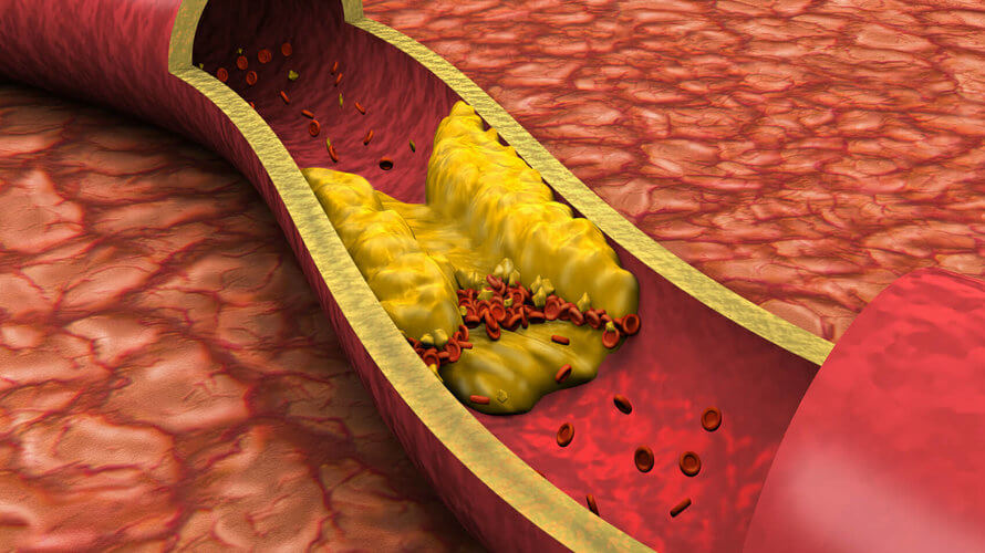 Hiperkolesterolemija u krvnim žilama